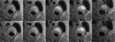 Predictors of Progression in Intraplaque Hemorrhage Volume in Patients With Carotid Atherosclerosis: A Serial Magnetic Resonance Imaging Study